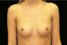 Breast Augmentation