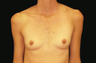 Breast Implants