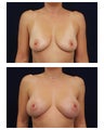 Breast Augmentation
