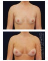 Breast Augmentation