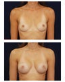 Breast Augmentation