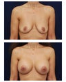 Breast Augmentation