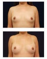 Breast Augmentation