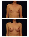 Breast Augmentation