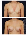 Breast Augmentation