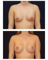 Breast Augmentation