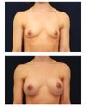 Breast Augmentation