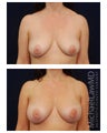 Breast Augmentation