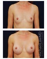Breast Augmentation