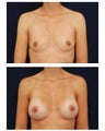 Breast Augmentation