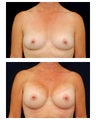 Breast Augmentation