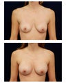 Breast Augmentation