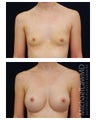 Breast Augmentation