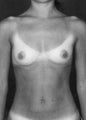 Breast Augmentation