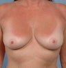 Breast Augmentation