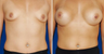 Breast Implants