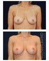 Breast Augmentation with Lift