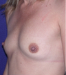 Breast Implants