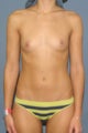 Breast augmentation