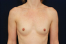 Breast Augmentation