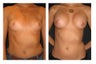 Breast Augmentation