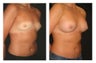 Breast Augmentation
