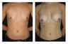 Breast Augmentation