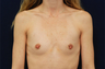 Breast Augmentation