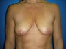 Breast Implants