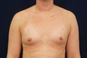 Breast Augmentation