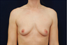 Breast Augmentation