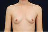 Breast Augmentation