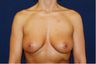 Breast Augmentation