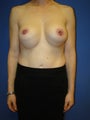 Silicone breast implant revision surgery