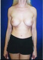 Revisionary Breast Augmentation