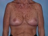 Breast Lift Surgery