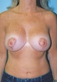 Vertical Breast Lift with Saline Implants