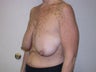 Breast Lift Surgery