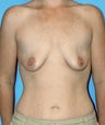 Breast Augmentation with Lift