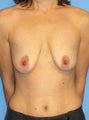Breast Augmentation with Lift