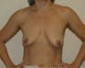 Tear Drop Augmentation Mastopexy