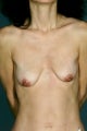 Tear Drop Augmentation Mastopexy