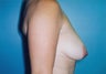Vertical Mastopexy (Breast Lift) w/ Saline Implants