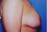 Breast lift (without implants)