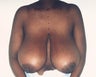 Breast Lift