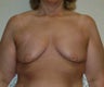 43 year old female, bilateral breast augmentation with peri-areolar mastopexy