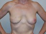Breast Reconstruction
