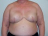 Breast Reconstruction