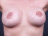 38 Year Old for Breast Reconstruction