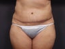 Post Tram Flap Abdomen - 46 Year Old Female for Breast Reconstruction